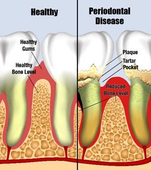 Gum disease