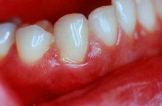 Gum disease1