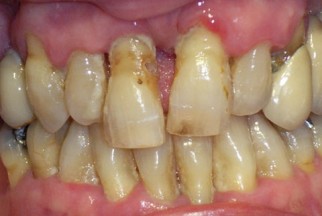 Gum disease2